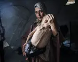 Een moeder troost haar ondervoede kind in een tent. Dit is wat er gebeurt in Gaza: honger en wanhoop.
